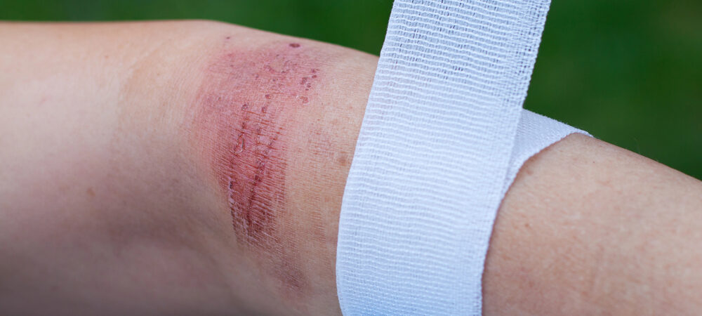 Healing dog bite wound