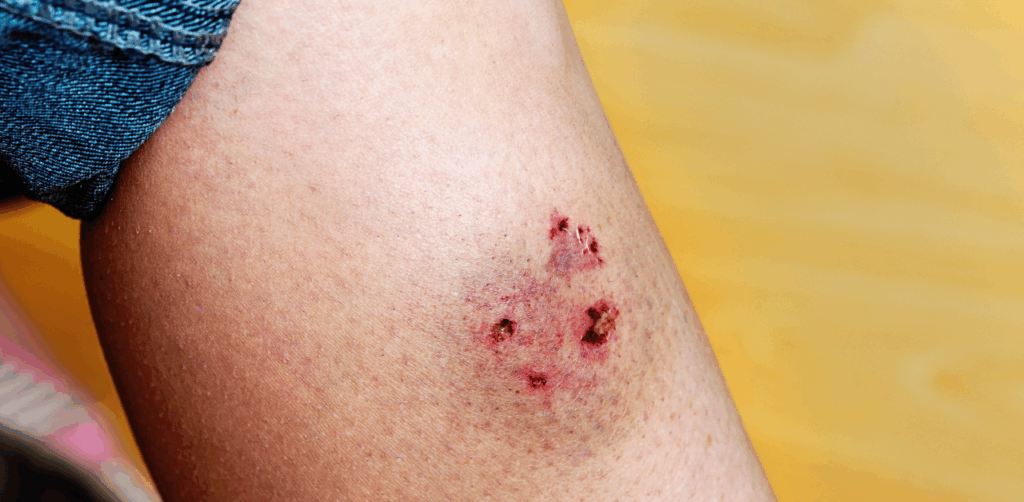 Close-up of a dog bite injury on a person’s leg with red puncture wounds and broken skin