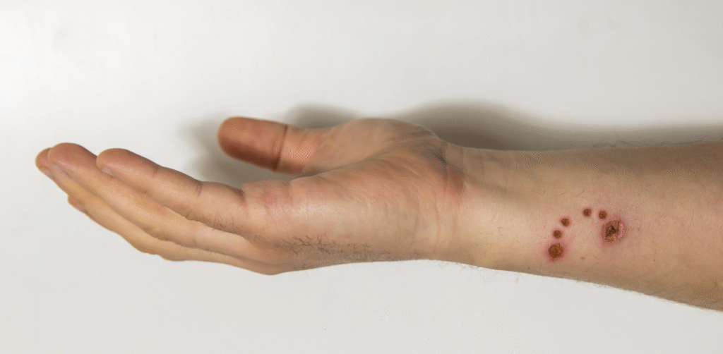 Outstretched forearm with red, inflamed bite marks in a semicircle pattern on the wrist, isolated against a plain white background